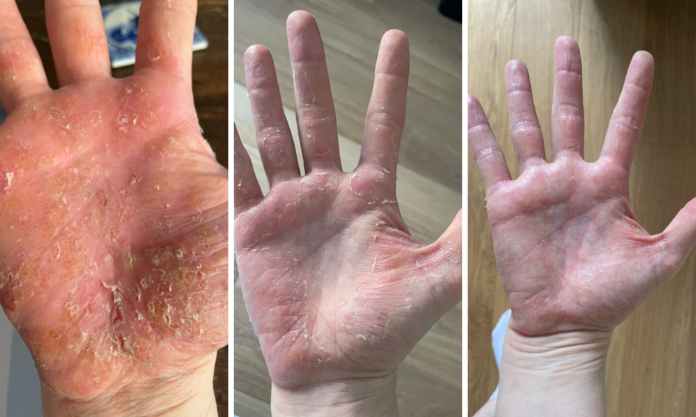 Dyshidrotic Eczema or Pompholyx, on the hands a before and after , showing blistered hands, peeling and then smooth  and healed