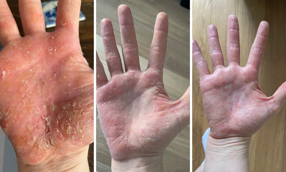 Dyshidrotic Eczema or Pompholyx, on the hands a before and after , showing blistered hands, peeling and then smooth  and healed