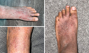 image of foot as it heals from using steroids, tsw and eczema, before and after 
